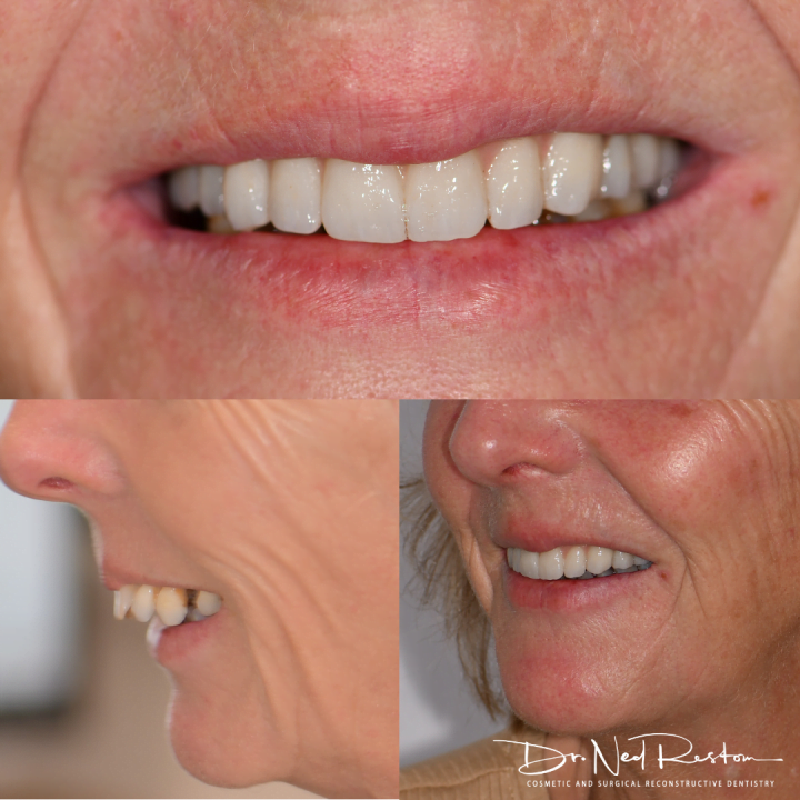 Ned Restom - Smile On Clinics - Teeth on Implants