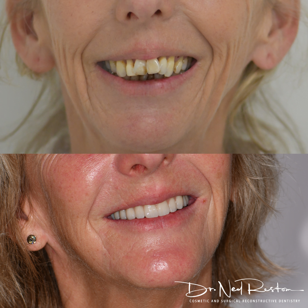 Avoca Beach - Smile On Clinics - Teeth on Implants