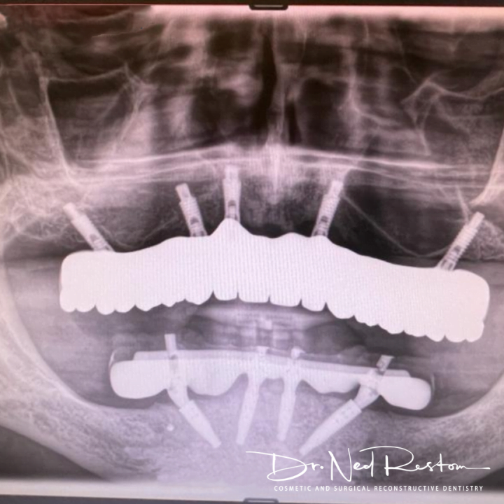 Ned Restom -  Smile On Clinics - Teeth on Implants