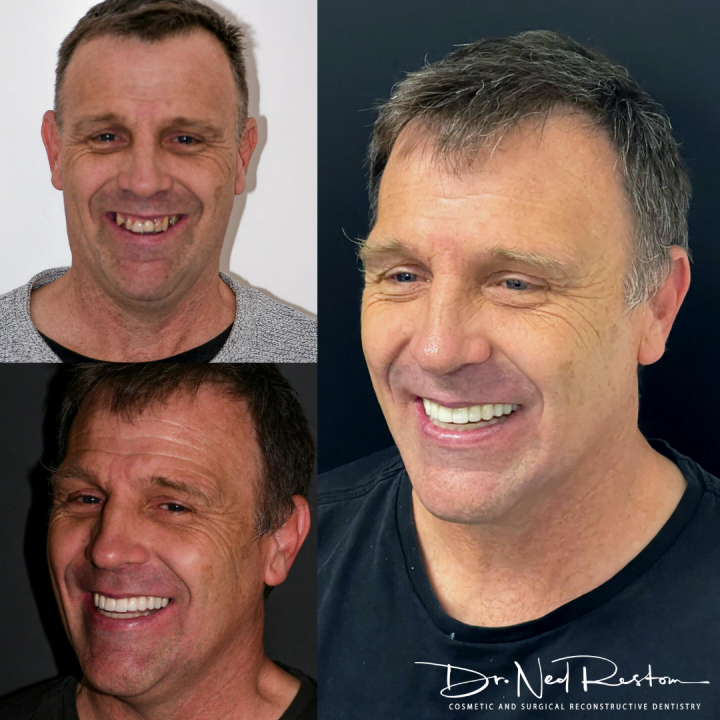 Ned Restom - Smile On Clinics - Teeth on Implant
