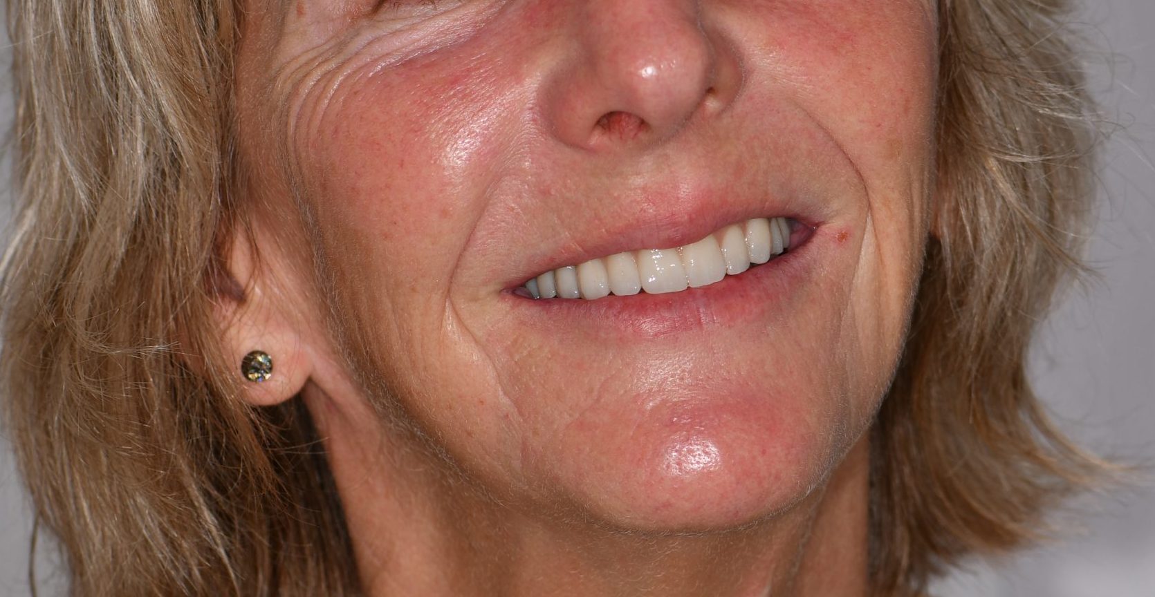 Teeth on Implants - Avoca Beach Dental - Dr Ned Restom
