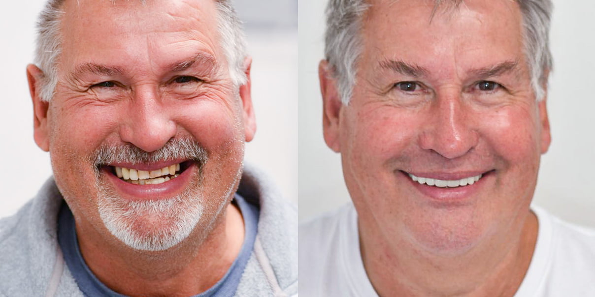 Teeth on Implants Before & After